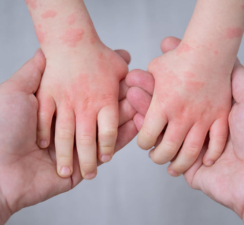 14 Eylül Atopik Dermatit Günü: Ailelere Özel Güncel Bakım ve Tedavi Rehberi - Mustela Türkiye - 1