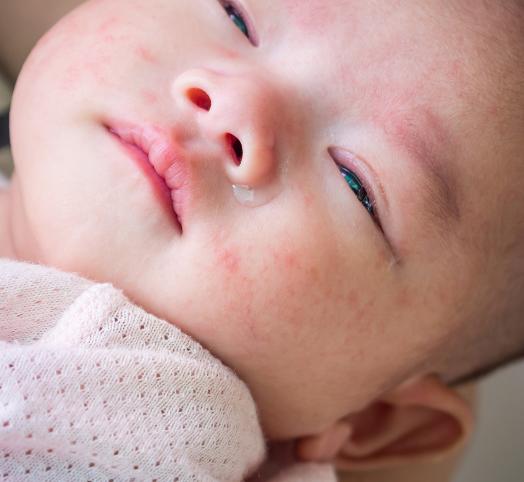 Atopiye eğilimli cildi nedeniyle bebeğim uyumakta zorlanıyor. Bu konuda ne yapabilirim?