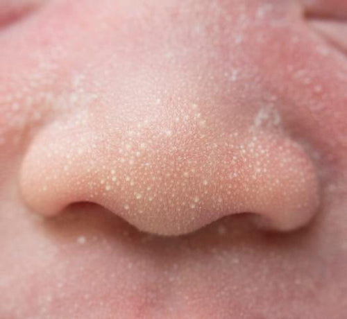 Bebeklerde Milia Nedir, Tedavisi Nasıldır? - Mustela Türkiye - 1