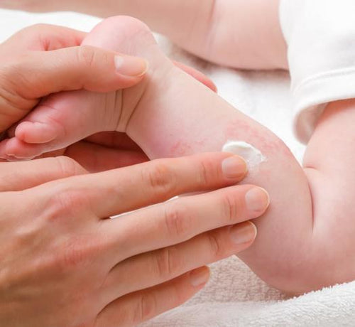 Bebeklerde İsilik Nedir, Nasıl Geçer? - Mustela Türkiye - 1