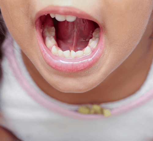 Çocuklarda Dil Bağı Nedir, Nasıl Tedavi Edilir? - Mustela Türkiye - 1