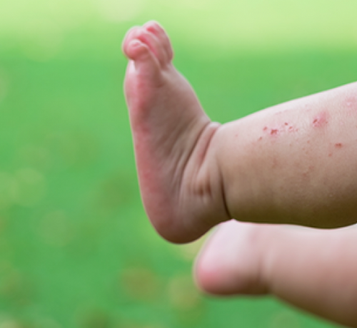 Çocuklarda ve bebeklerde yara izi - Mustela Türkiye - 1