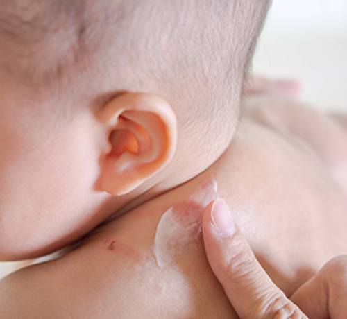 Tahriş olmuş bebek cildi nasıl rahatlatılır ? - Mustela Türkiye - 1