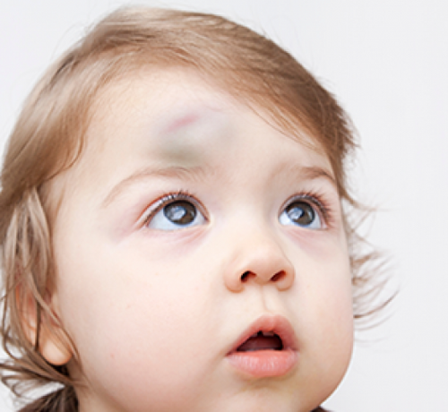 Bebeklerde düşme ya da çarpma sonucu oluşan şişlikler ve renk değişimleri - Mustela Türkiye - 1