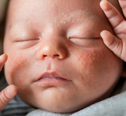 Atopik Dermatit ile Yaşayan Çocuklar ve Aileleri İçin 14 Eylül Rehberi - Mustela Türkiye - 1