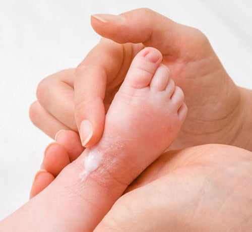 Bebeklerde Ürtiker (Kurdeşen) Nedir, Nasıl Geçer? - Mustela Türkiye - 1