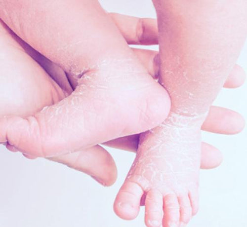 Bebeklerde Cilt Kuruluğu Nedenleri ve Kaşıntı - Mustela Türkiye - 1