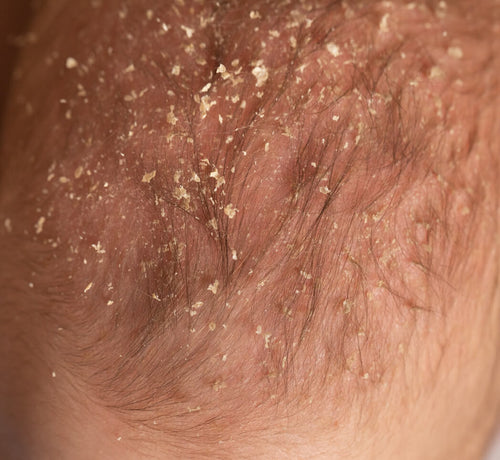 Bebeklerde Konak: Saç Derisinde Pullanma Nedir, Nasıl Geçer? - Mustela Türkiye - 1