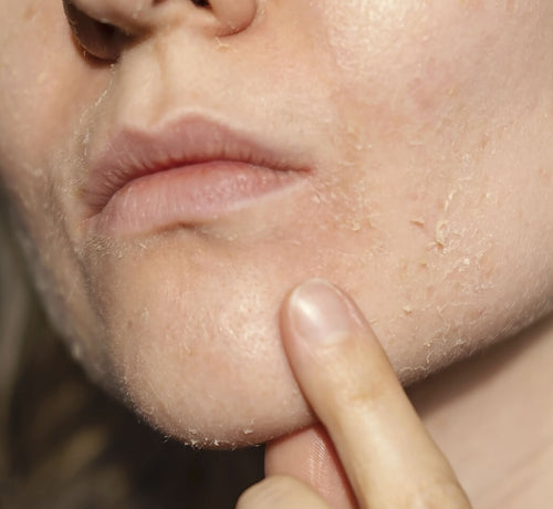 Cilt Kuruluğu Nedir ve Nedenleri Nelerdir? - Mustela Türkiye - 1