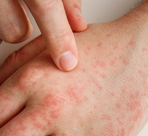 Dunya_Atopik_Dermatit_Gunu-_Farkindalik_Yaratmanin_Onemi_COVER_98c6364f-82fb-488a-9449-b735dd2a5f65 - Mustela Türkiye - 1