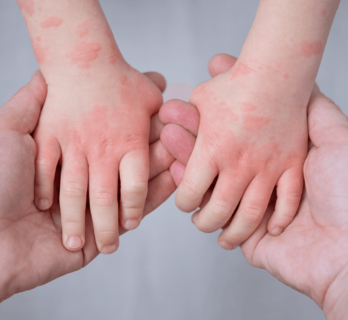 EGZAMA_NEDIR_BELIRTILERI_VE_TEDAVISI_1048X964PX_1caeef8d-b036-4481-83a3-6aeea3084a4a - Mustela Türkiye - 1