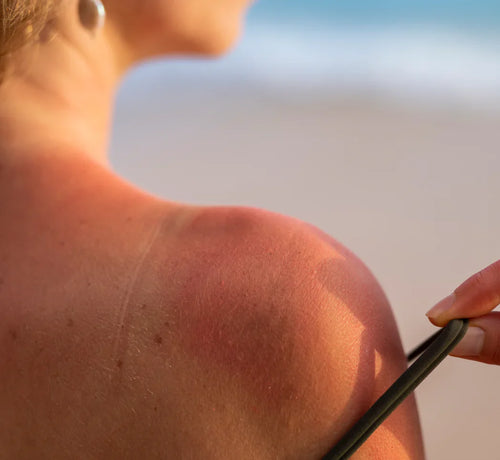 Güneş Yanıklarına Ne İyi Gelir? - Mustela Türkiye - 1