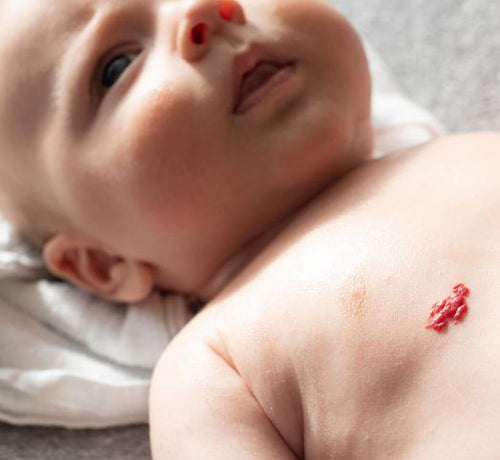 Hemanjiyom (Damar Beni) Nedir, Nasıl Tedavi Edilir? - Mustela Türkiye - 1