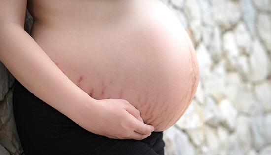 Hamilelik ve Doğum Sonrası Cilt Bakımı: Çatlaklarla Mücadele