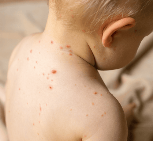 Kızamık Nedir? Belirtileri ve Tedavisi - Mustela Türkiye - 1