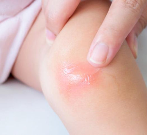 Bebeklerde Kızarıklık ve Kabarma - Mustela Türkiye - 1