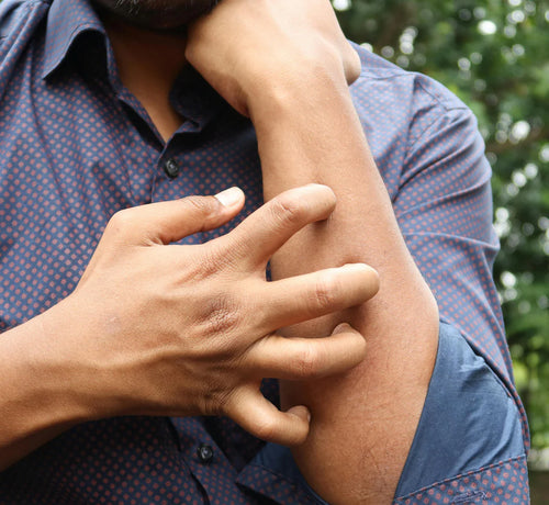 Kaşıntı Neden Olur? Kaşıntıya Ne İyi Gelir? - Mustela Türkiye - 1