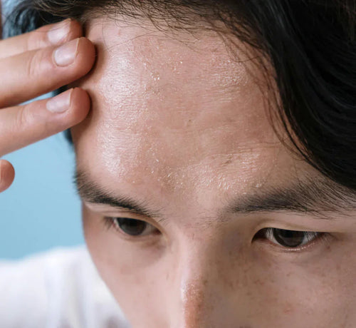 Seboreik Dermatit Nedir, Nasıl Geçer? - Mustela Türkiye - 1